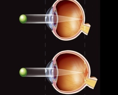 Pathological Myopia - PORTAL MyHEALTH