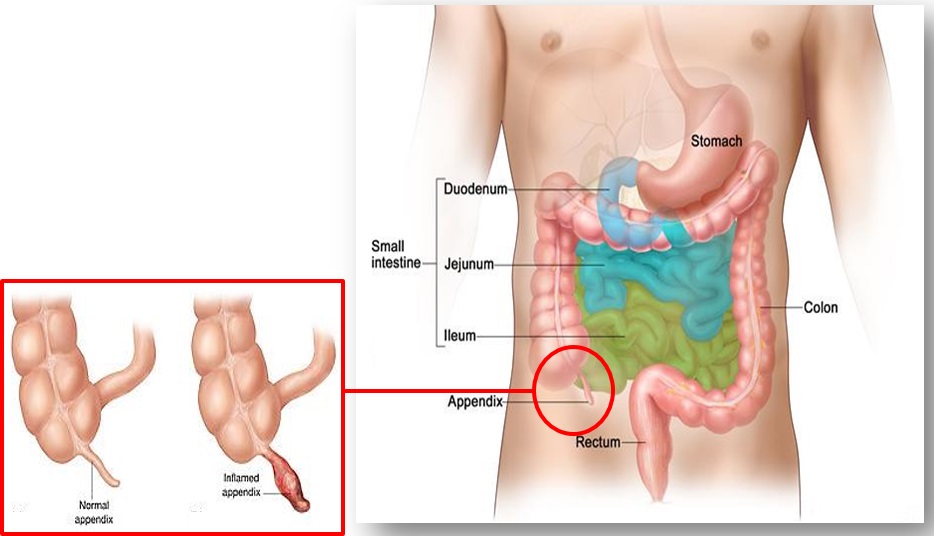 appendicitis-in-telugu-appendicitis-causes-and-symptoms-in-telugu