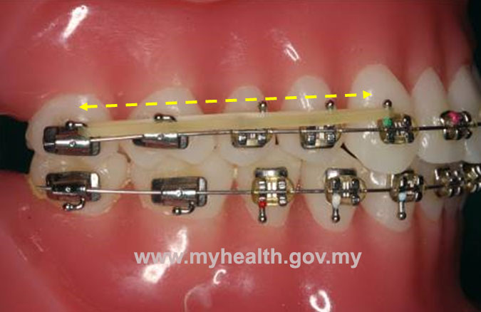 rubber band to close teeth gap