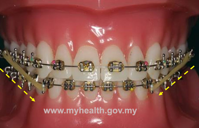 How to change the colorful rubber bands for orthodontics. Make sure to, Rubber Band Braces