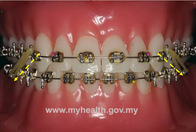 can you buy teeth effect bands stores