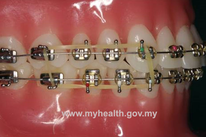heavy rubber bands for braces