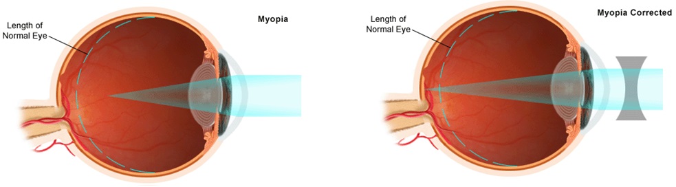 High Myopia PORTAL MyHEALTH