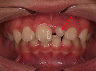 impacted front teeth
