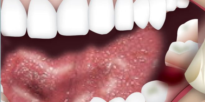 wisdom teeth symptoms ulcers