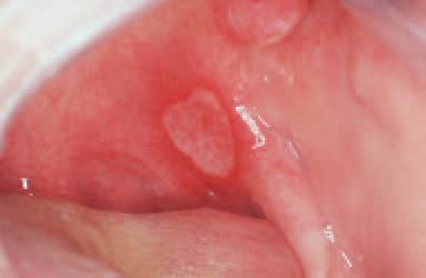 aphthous stomatitis in children