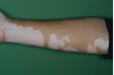 Vitiligo punca penyakit Penawar Penyakit